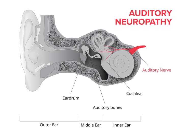 نوروپاتی گوش